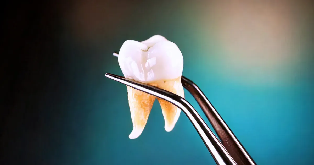 Intraoral view before and after a tooth extraction procedure