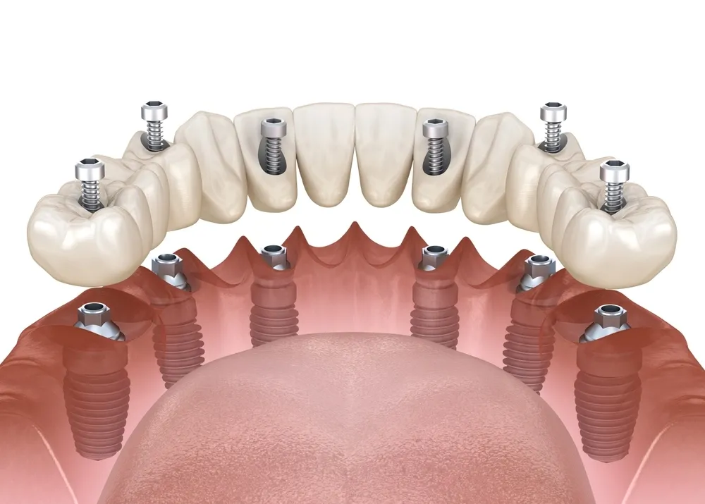 Diagram of six dental implants placed in the jaw using the All on 6 technique