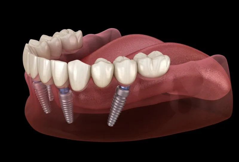 Diagram of four dental implants placed at an angle in the jaw using the All on 4 technique