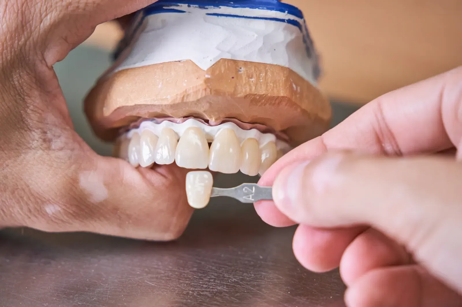 Close-up of front teeth restored with E-Max Empress veneers