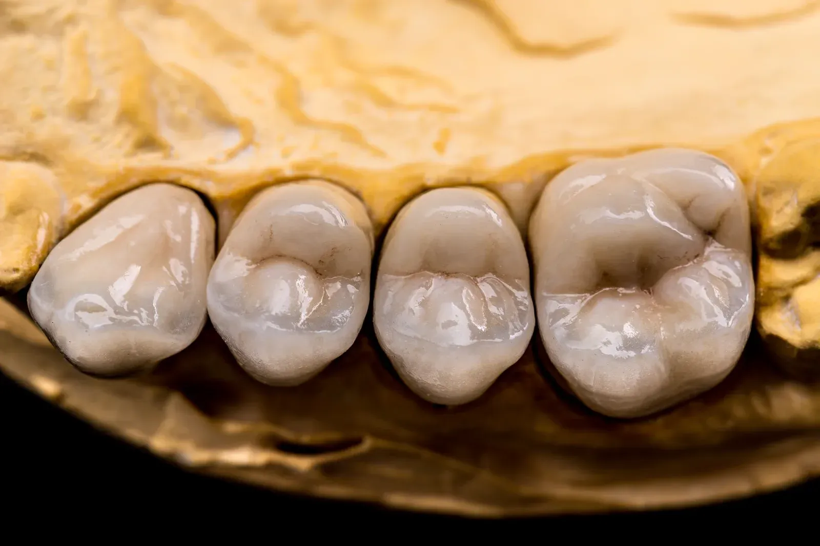 Close-up of a smile restored with zirconia crowns