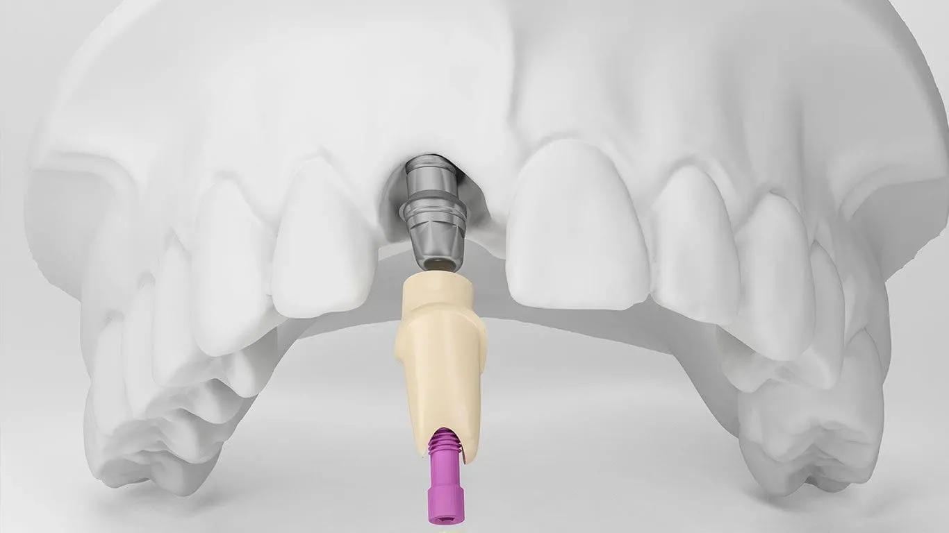 Three-dimensional cross-section view of a dental implant placed in the lower jaw
