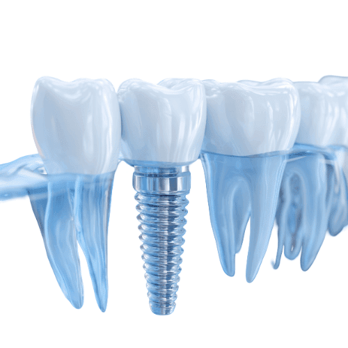 All On 4 Diş İmplantları