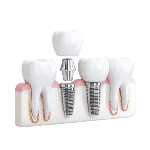 All On 6 Diş İmplantları