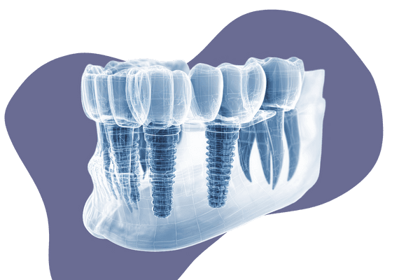 All-on-6 Dental Implant
