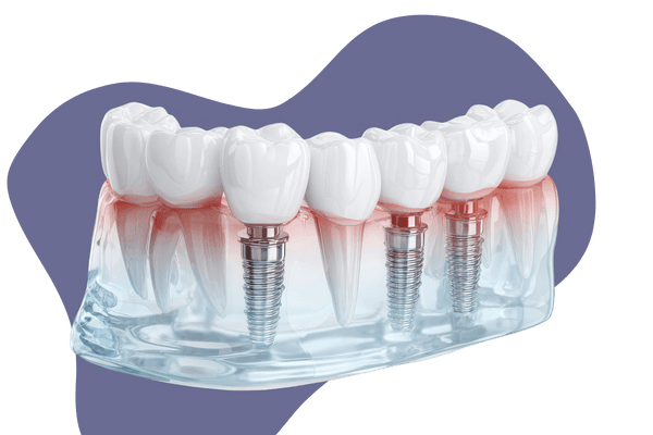 All-on-4 Dental Implant Treatment