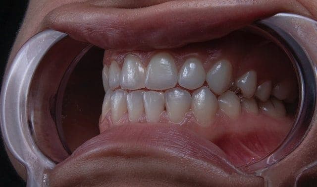 Zirconium dental crowns result