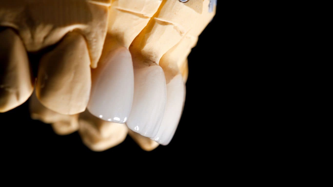 Zirconium veneers result 1