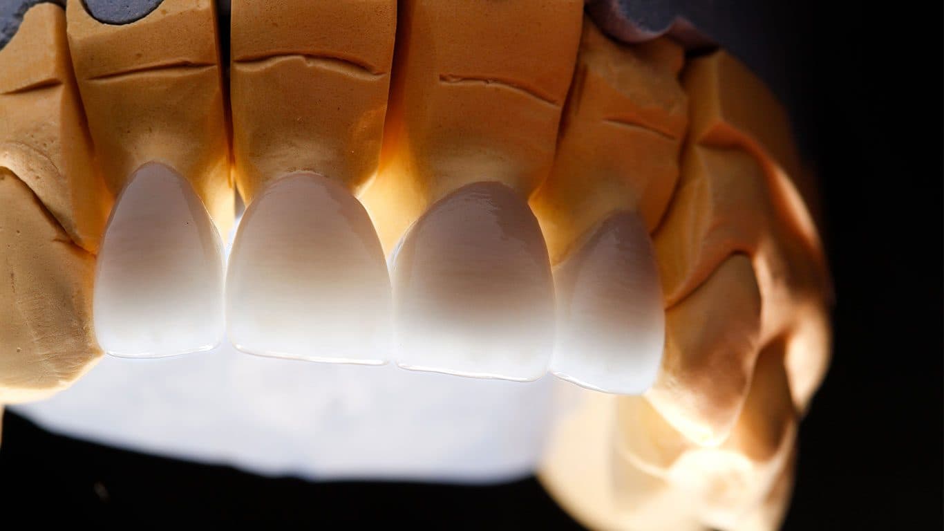 Zirconium veneers result 3